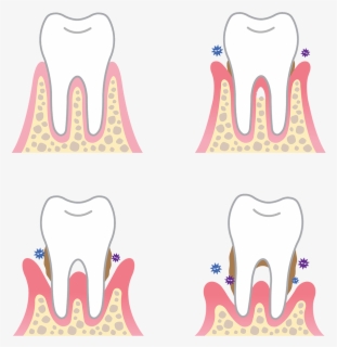 Advanced Periodontitis Illustration - Periodontal Disease Causes , Free ...