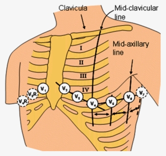 Pulmonary Embolism Clipart , Free Transparent Clipart - ClipartKey