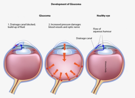 Transparent Chronic Clipart - Laser Cycloablation , Free Transparent ...