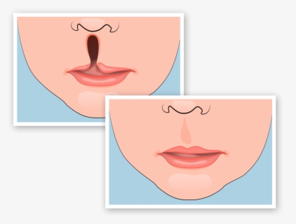 Before And After Illustration Of Cleft Lip Surgery - Lips With Cleft ...