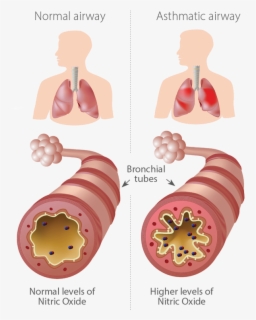 Infographic Of Normal And Asthmatic Airways - Whats In An Inhaler ...