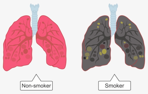 Transparent Human Body Clipart - Smokers Lungs Png Transparent , Free ...