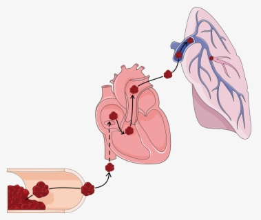 pulmonary-embolism-clip-art-free-transparent-clipart-clipartkey